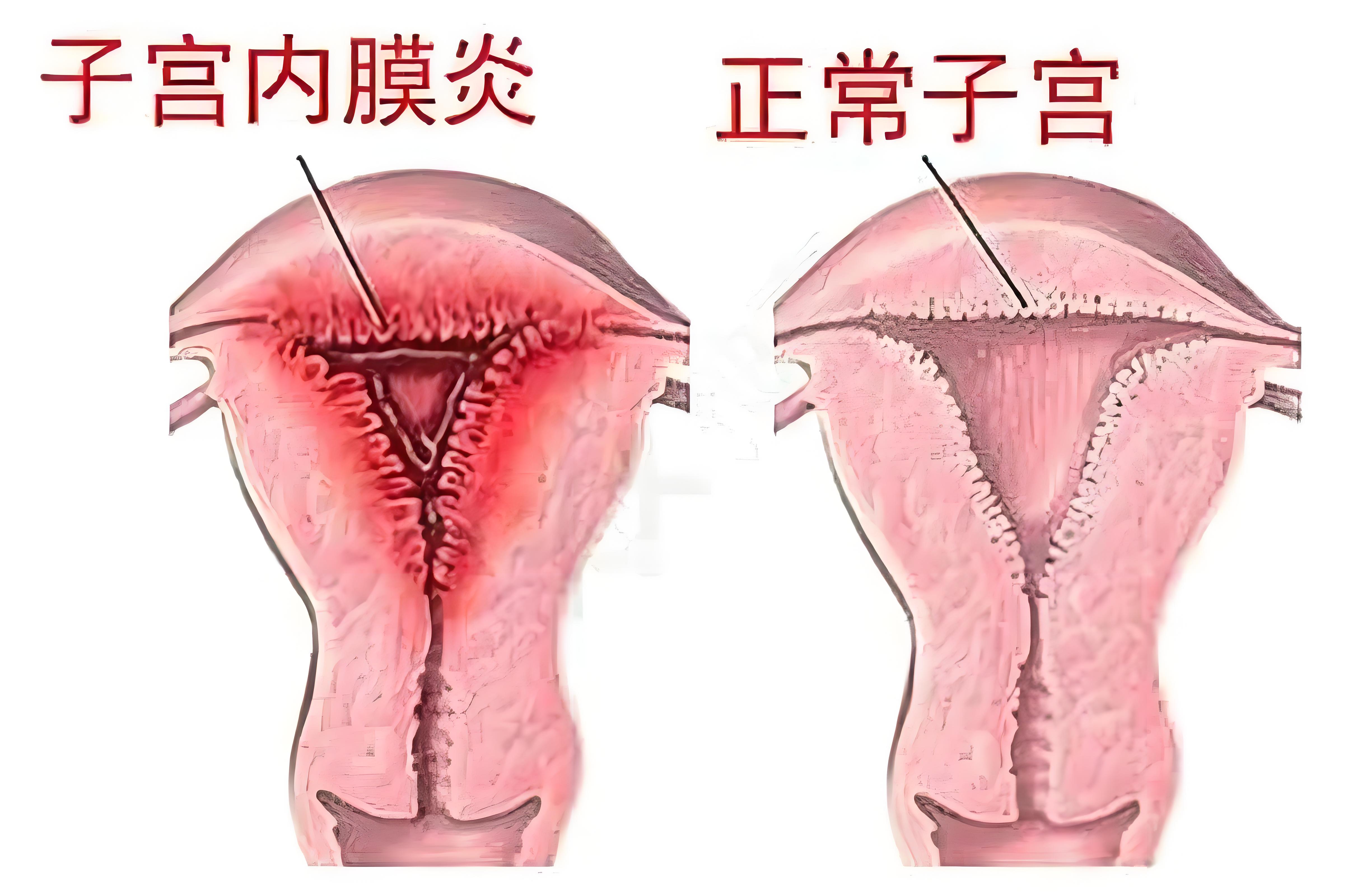 慢性子宫内膜炎不痛不痒，凭什么会导致女性不孕？